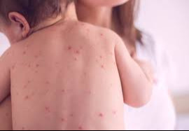 Улаанбурханы есөн тохиолдол батлагджээ